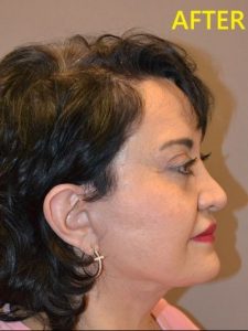 after facelift right side view of female patient case 2686