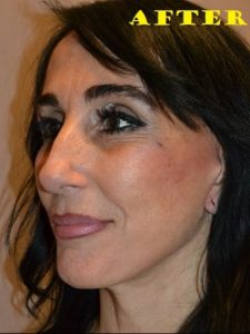 after facelift left angle view of female patient case 2690