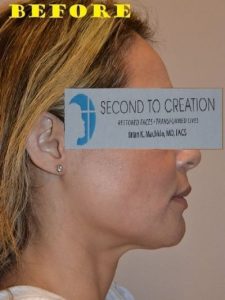 before facelift right side view of female patient case 2693