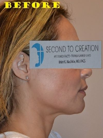 before facelift right side view of female patient case 2693