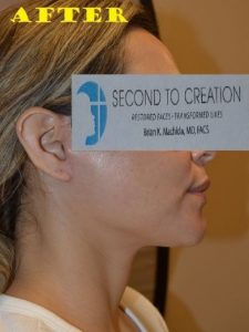 after facelift right side view of female patient case 2693