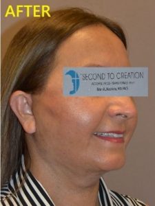 after facelift right angle view of female patient case 2696