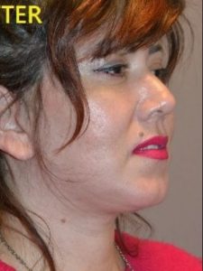 after facelift right angle view of female patient case 2699