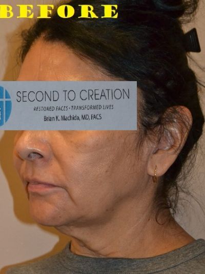 before facelift left angle view of female patient case 2702