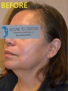 before facelift left angle view of female patient case 2705