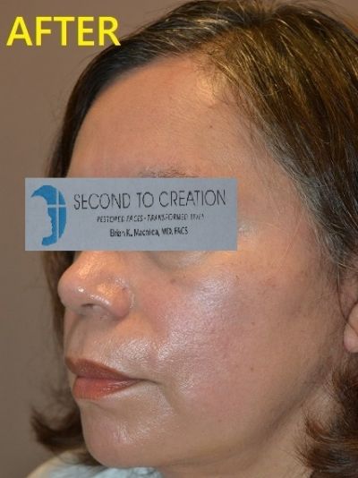 after facelift left angle view of female patient case 2705