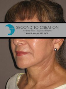 after facelift left angle view of female patient 706