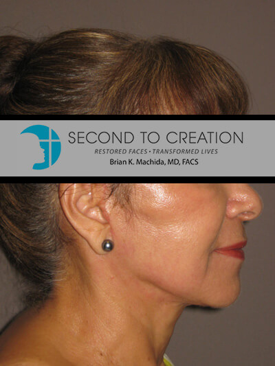 after facelift right side view of female patient 706