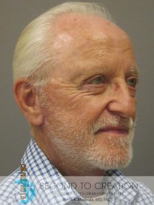 after facelift right angle view of male patient 754