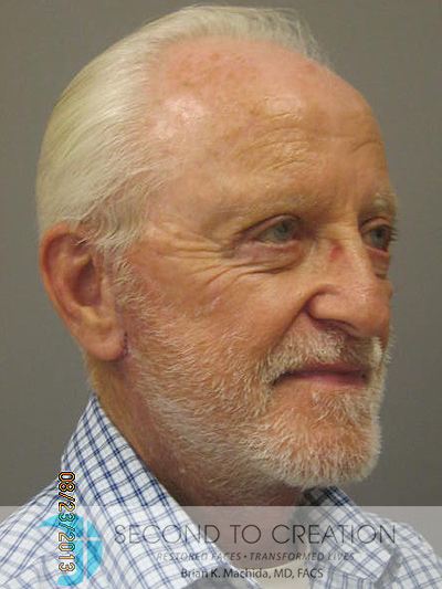 after facelift right angle view of male patient 754