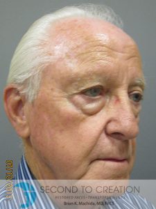 before facelift right angle view of male patient 754