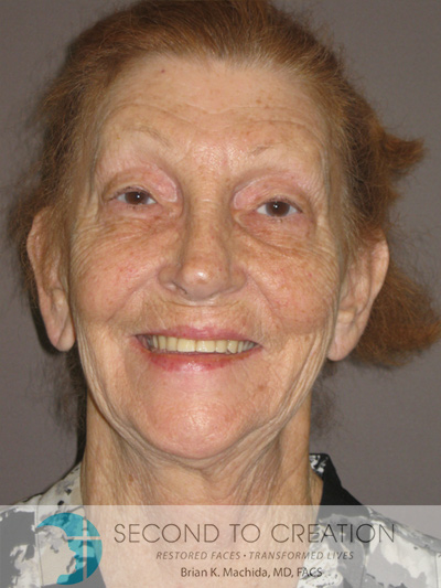 before facelift front view of female patient 766