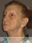 before facelift left angle view of female patient 766