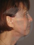 after facelift right side view of female patient 967
