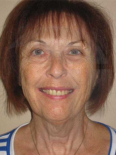 before facelift front view of female patient 967