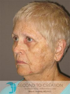 before facelift left angle view of female patient 984