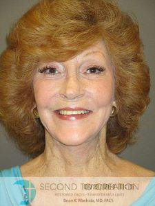 after fractional laser front view of female patient 1041