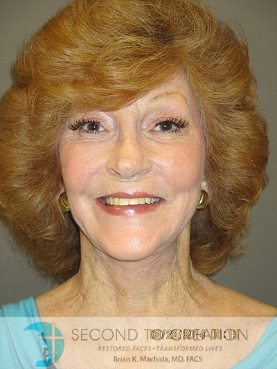 after fractional laser front view of female patient 1041