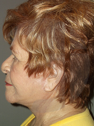 after fractional laser left side view of female patient 1046