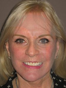 after fractional laser front view of female patient 1051