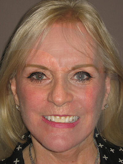 after fractional laser front view of female patient 1051