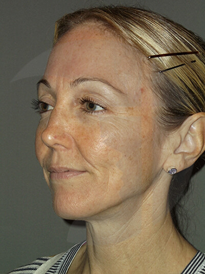 before fractional laser left angle view of female patient 1058