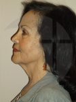before neck lift left side view of female patient 1104