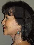 after neck lift left side view of female patient 1104