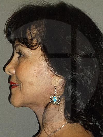 after neck lift left side view of female patient 1104