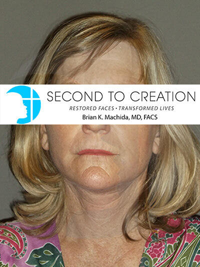 after neck lift front view of female patient 1113