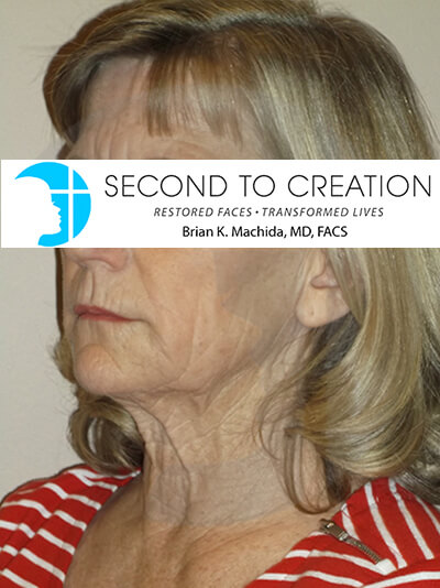 before neck lift left angle view of female patient 1113