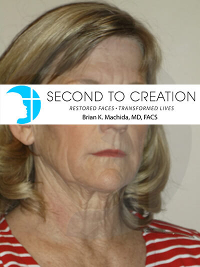 before neck lift right angle view of female patient 1113