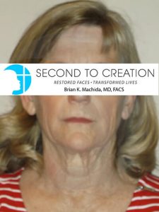 before neck lift front view of female patient 1113