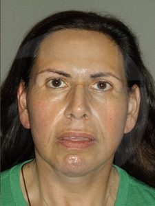 after neck lift front view of female patient 1120