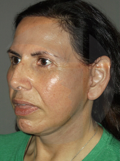 after neck lift left angle view of female patient 1120