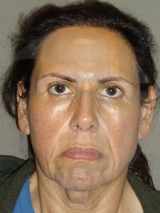 before neck lift front view of female patient 1120