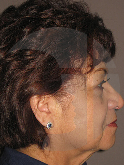 before neck lift right side view of female patient 1125