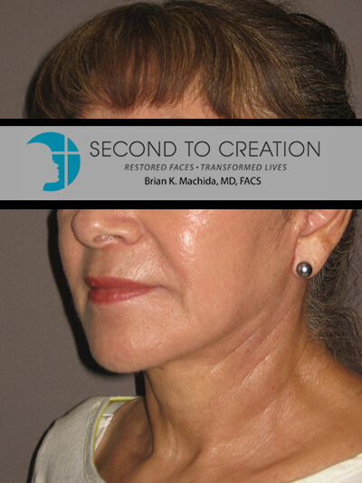 after neck lift left angle view of female patient 1135