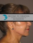 after neck lift right side view of female patient 1135