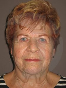 before neck lift front view of female patient 1140