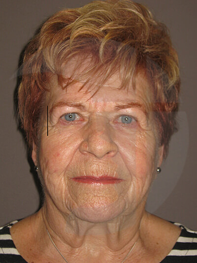 before neck lift front view of female patient 1140