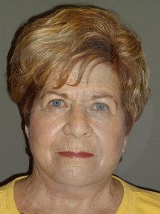 after neck lift front view of female patient 1140