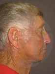 after neck lift right side view of male patient 1145