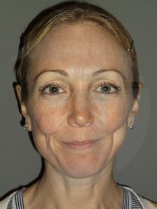 before neck lift front view of female patient 1152