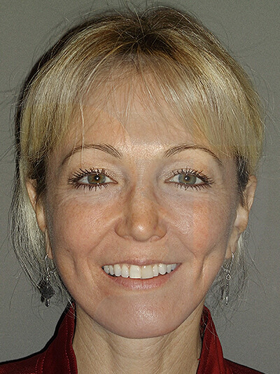 after neck lift side front of female patient 1152