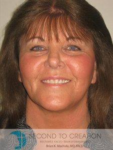 after neck lift front view of female patient 1166