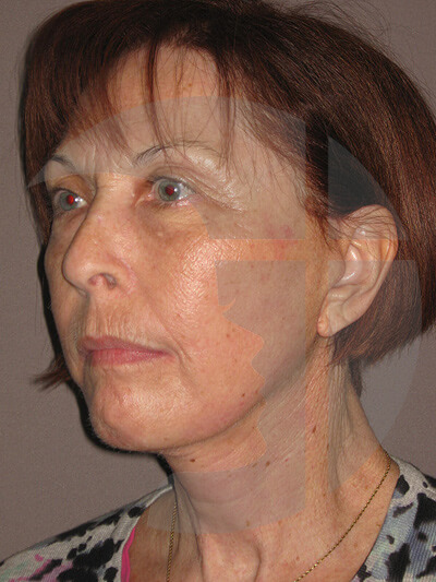 after neck lift left angle view of female patient 1171