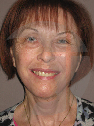 after neck lift front view of female patient 1171