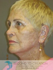 after neck lift left angle view of female patient 1180