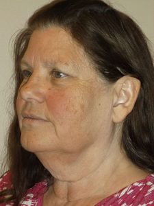 before neck lift angle view of female patient 14